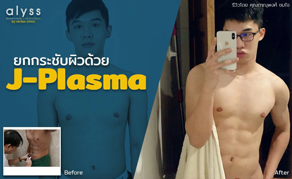 J-Plasma