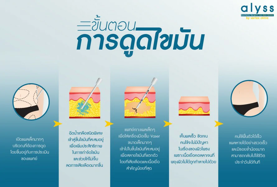how-to-vaser