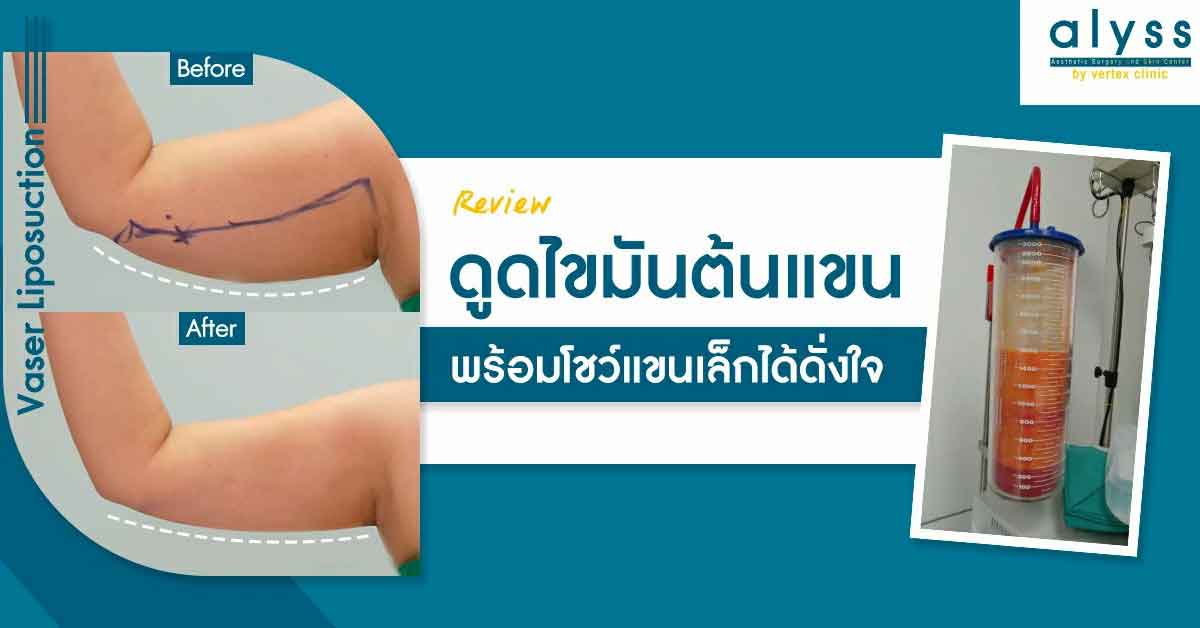 [รีวิวดูดไขมัน] ดูดไขมันต้นแขน โบกมือลาแขนใหญ่ พร้อมโชว์แขนเล็กได้ดั่งใจ