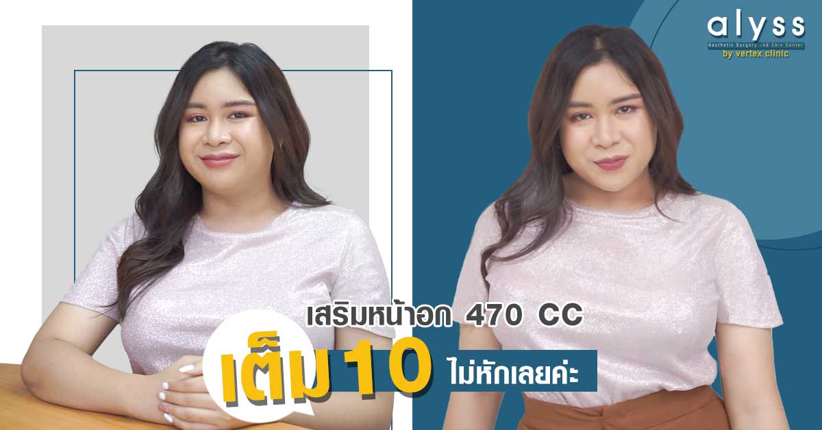 [รีวิวเสริมหน้าอก] รีวิวทำนม เสริมหน้าอกแบบธรรมชาติที่คลินิกเสริมหน้าอก Alyss by Vertex Clinic