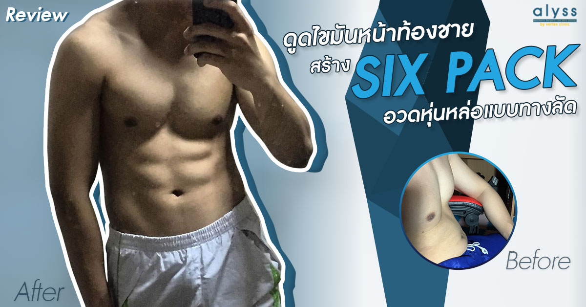 [รีวิวดูดไขมัน] ดูดไขมันสร้าง six pack ทางลัดของคนอยากมีซิกแพค