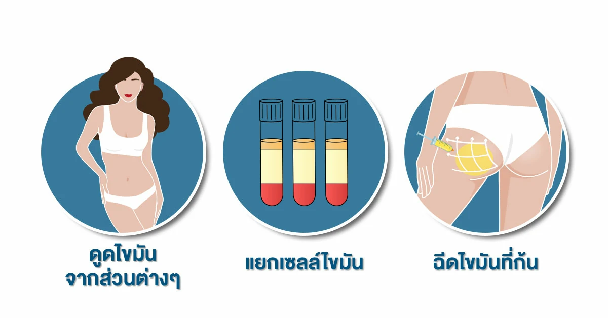 ฉีดไขมันก้น-เสริมก้นเด้ง