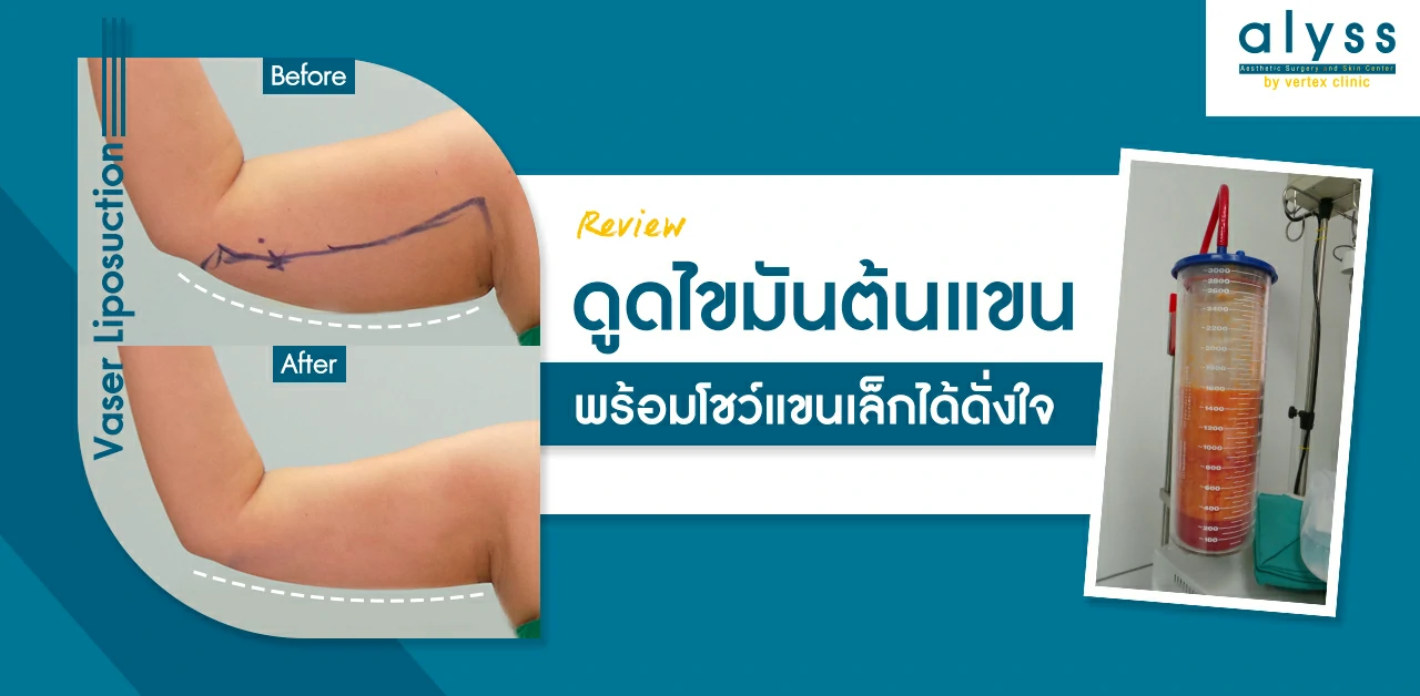 ดูดไขมันต้นแขนรีวิว-ดูดไขมันแขนรีวิว