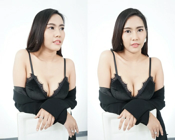 ทำนม-เสริมหน้าอก