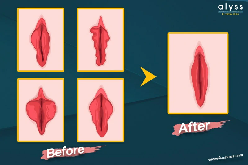 ภาพตัวอย่างเลเบีย