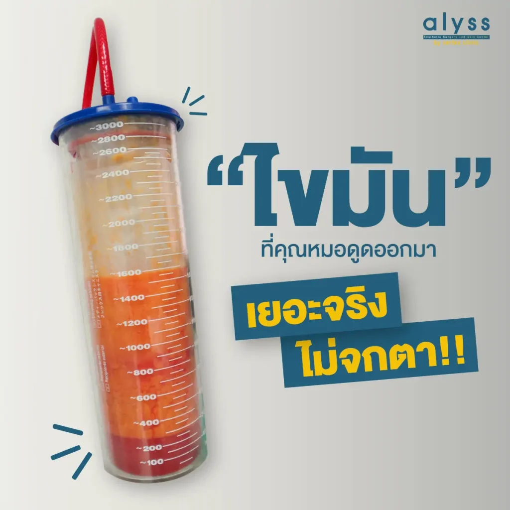 มวลไขมัน-ดูดไขมัน