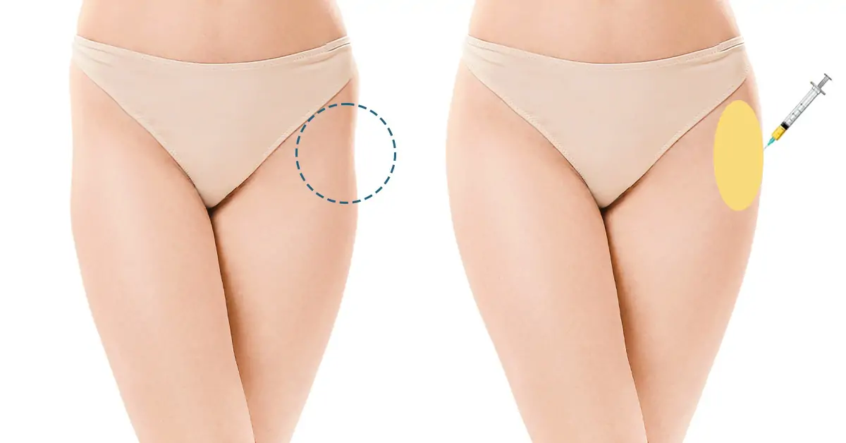 รีวิว-สะโพกบุ๋ม-เติมไขมันสะโพก